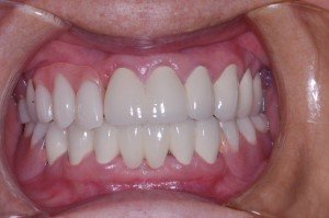Partial Dentures after 2