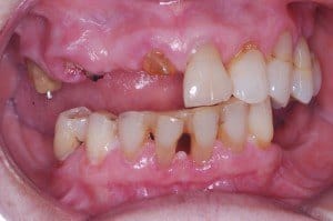 Partial Dentures before 2