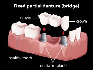 A fixed partial denture