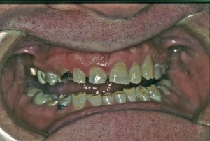 Full Mouth Reconstruction before