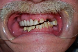 Partial Dentures before