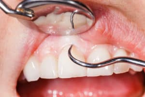 Gum Disease and Stroke